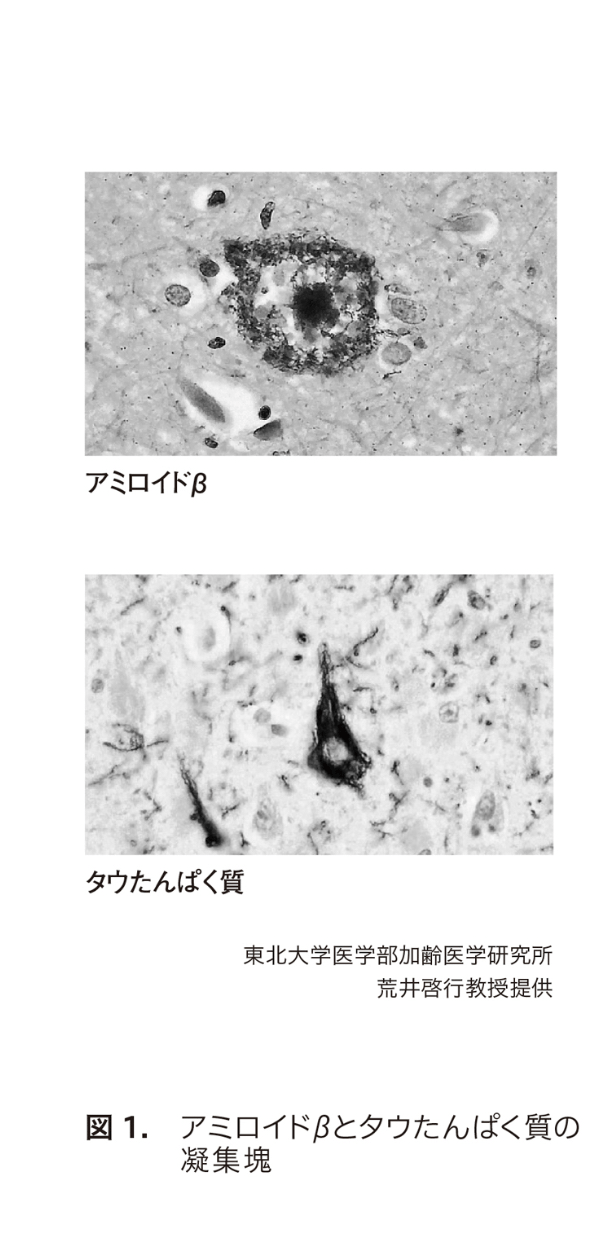 アミロイドβとタウタンパク質