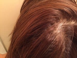 女性も薄毛になるの?