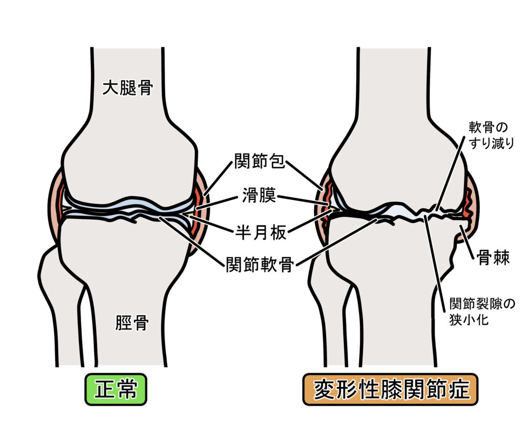 正常な膝と変形性膝関節症の膝の比較画像。軟骨がすり減っている。