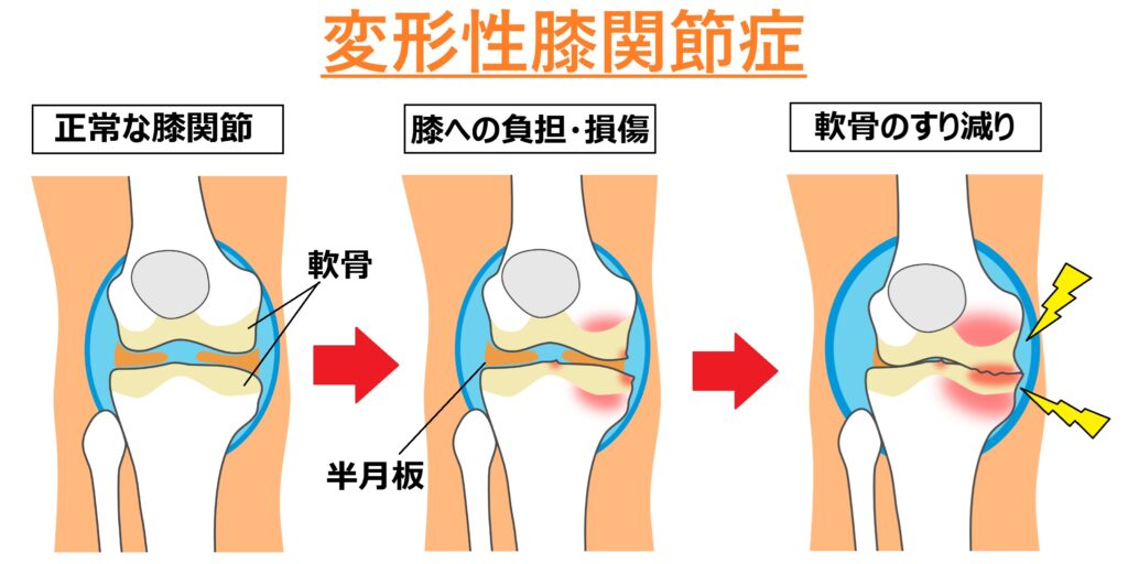 [説明図]変形性関節症のメカニズム。膝への負担や損傷により軟骨がすり減る。