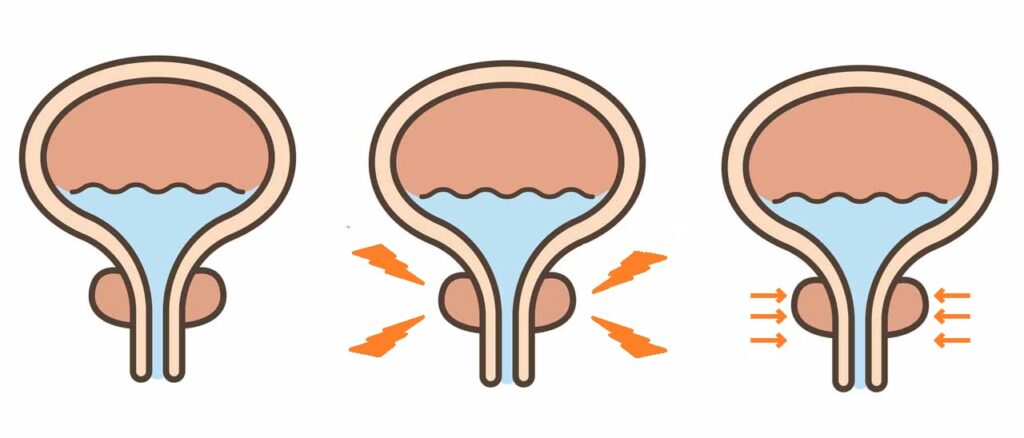 前立腺の肥大により尿道を狭め頻尿につながる